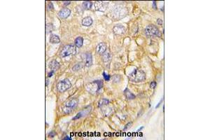 Formalin-fixed and paraffin-embedded human prostata carcinoma tissue reacted with DRAGON (RGMB) , which was peroxidase-conjugated to the secondary antibody, followed by DAB staining. (RGMB 抗体  (C-Term))