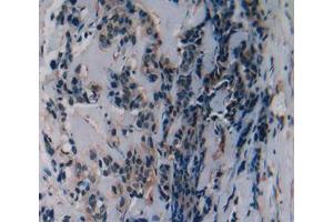 IHC-P analysis of breast cancer tissue, with DAB staining. (SLURP1 抗体  (AA 1-103))
