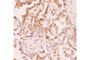 Anti-SIRT2 Picoband antibody,  IHC(P): Human Lung Cancer Tissue (SIRT2 抗体  (Middle Region))