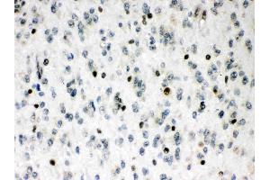 MEF2A was detected in paraffin-embedded sections of human glioma tissues using rabbit anti- MEF2A Antigen Affinity purified polyclonal antibody (Catalog # ) at 1 µg/mL. (MEF2A 抗体  (C-Term))
