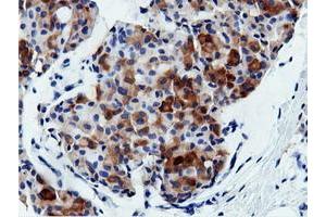 Immunohistochemical staining of paraffin-embedded Adenocarcinoma of Human breast tissue using anti-AK5 mouse monoclonal antibody. (Adenylate Kinase 5 抗体)