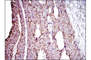 Immunohistochemical analysis of paraffin-embedded rectum cancer tissues using ALDH2 mouse mAb with DAB staining.