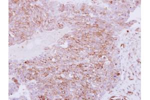 IHC-P Image Immunohistochemical analysis of paraffin-embedded human ovarian carcinoma, using RhoC, antibody at 1:250 dilution. (RHOC 抗体)