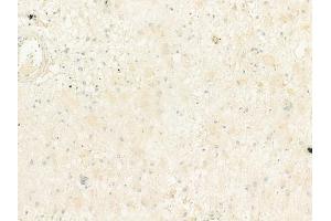 ABIN6264450 and ABIN6273067 at 1/100 staining human astrocytoma by IHC-P. (PRPH2 抗体  (Internal Region))