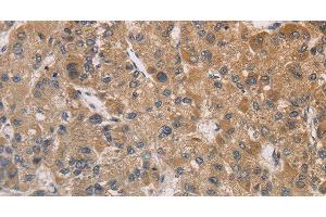 Immunohistochemistry of paraffin-embedded Human liver cancer tissue using DSTN Polyclonal Antibody at dilution 1:30 (Destrin 抗体)