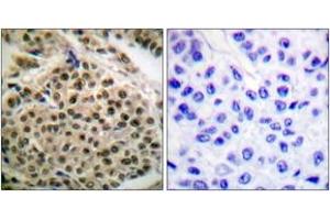 Immunohistochemistry analysis of paraffin-embedded human breast carcinoma, using NF-kappaB p105/p50 (Phospho-Ser927) Antibody. (NFKB1 抗体  (pSer927))