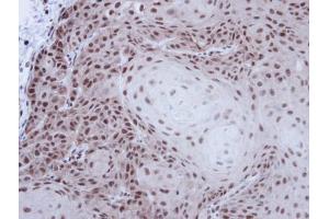 IHC-P Image Immunohistochemical analysis of paraffin-embedded Cal27 xenograft, using p54/nrb , antibody at 1:100 dilution. (NONO 抗体  (N-Term))