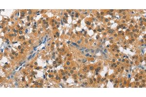 Immunohistochemistry of paraffin-embedded Human thyroid cancer tissue using CUL7 Polyclonal Antibody at dilution 1:50 (Cullin 7 抗体)