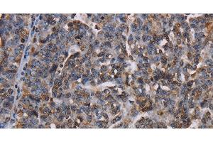 Immunohistochemistry of paraffin-embedded Human ovarian cancer using LBR Polyclonal Antibody at dilution of 1:50 (Lamin B Receptor 抗体)