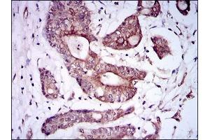 Immunohistochemical analysis of paraffin-embedded colon cancer tissues using BMPR1A mouse mAb with DAB staining. (BMPR1A 抗体  (AA 179-378))