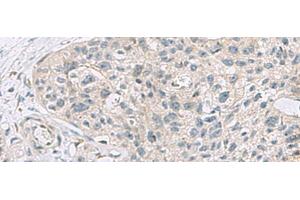 Immunohistochemistry of paraffin-embedded Human esophagus cancer tissue using ABCA10 Polyclonal Antibody at dilution of 1:50(x200) (ABCA10 抗体)