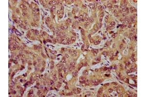 IHC image of ABIN7171794 diluted at 1:800 and staining in paraffin-embedded human liver cancer performed on a Leica BondTM system. (TES 抗体  (AA 130-260))
