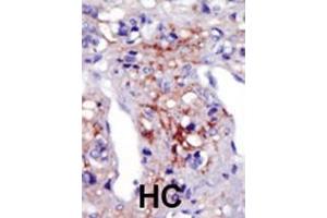 Formalin-fixed and paraffin-embedded human cancer tissue reacted with the primary antibody, which was peroxidase-conjugated to the secondary antibody, followed by AEC staining. (PIP5K1C 抗体  (N-Term))