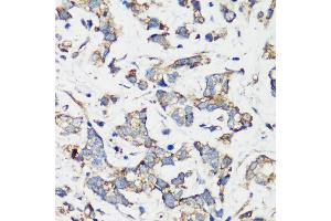 Immunohistochemistry of paraffin-embedded human gastric cancer using TSC1 antibody (ABIN6133755, ABIN6149609, ABIN6149610 and ABIN6213968) at dilution of 1:200 (40x lens). (TSC1 抗体  (AA 550-650))