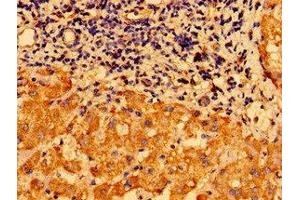 Immunohistochemistry of paraffin-embedded human liver cancer using ABIN7147612 at dilution of 1:100 (CHDH 抗体  (AA 30-223))