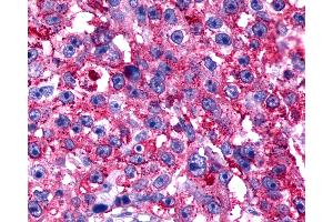 Anti-TPRA1 / GPR175 antibody IHC of human Breast, Carcinoma. (GPR175 抗体  (N-Term))