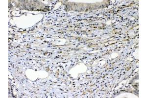 IHC testing of FFPE human intestinal cancer tissue with VEGFR2 antibody at 1ug/ml. (VEGFR2/CD309 抗体)
