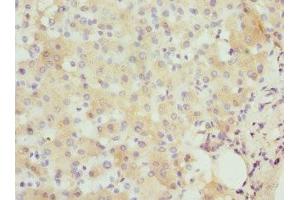 Immunohistochemistry of paraffin-embedded human liver cancer using ABIN7156584 at dilution of 1:100 (IFNB1 抗体  (AA 22-187))