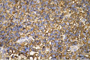 Immunohistochemistry was performed on paraffin-embedded human glioblastoma using pannexin 1 antibody (ABIN7799733), 1:200). (Recombinant PANX1 抗体)