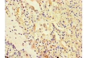 Immunohistochemistry of paraffin-embedded human lung cancer using ABIN7175178 at dilution of 1:100 (UVRAG 抗体  (AA 375-425))