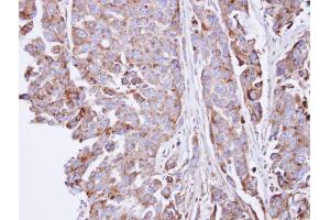 IHC-P Image Immunohistochemical analysis of paraffin-embedded OVCAR3 xenograft , using SGSH, antibody at 1:100 dilution. (SGSH 抗体  (C-Term))