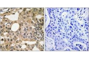 Immunohistochemistry analysis of paraffin-embedded human breast carcinoma tissue, using BCL-XL (Ab-115) Antibody. (BCL2L1 抗体  (AA 81-130))