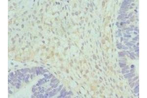 Immunohistochemistry of paraffin-embedded human ovarian cancer using ABIN7152037 at dilution of 1:100 (HSD17B2 抗体  (AA 118-387))