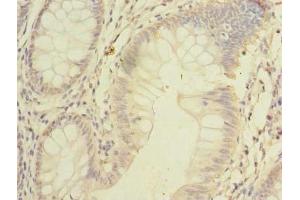 Immunohistochemistry of paraffin-embedded human colon cancer using ABIN7168953 at dilution of 1:100 (C7orf45 抗体  (AA 56-244))
