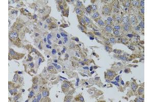 Immunohistochemistry of paraffin-embedded human breast cancer using GNA15 antibody (ABIN5971107) at dilution of 1/100 (40x lens). (GNA15 抗体)