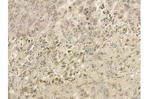 ABIN6261622 and ABIN6273240 at 1/100 staining human melanoma by IHC-P.