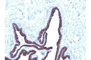Formalin-fixed, paraffin-embedded human Ovarian Cancer stained with Cytokeratin 8/18 Monoclonal Antibody (KRT8/803 + KRT18/835). (KRT8, KRT18 抗体)
