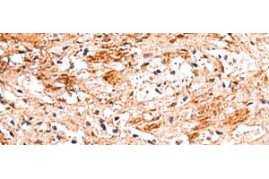 Immunohistochemistry of paraffin-embedded Human liver cancer tissue using NADK Polyclonal Antibody at dilution of 1:70(x200) (NADK 抗体)