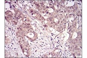 Immunohistochemical analysis of paraffin-embedded human cervical cancer tissues using RANBP9 mouse mAb with DAB staining. (Importin 9 抗体  (AA 453-680))