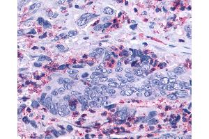 Anti-LTB4R2 / BLT2 antibody IHC of human Colon, Carcinoma and Leukocytes. (LTB4R2 抗体  (Cytoplasmic Domain))