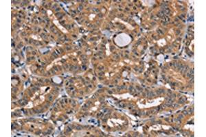 The image on the left is immunohistochemistry of paraffin-embedded Human thyroid cancer tissue using ABIN7131459(TRAFD1 Antibody) at dilution 1/20, on the right is treated with fusion protein. (TRAFD1 抗体)