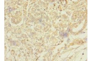Immunohistochemistry of paraffin-embedded human pancreatic cancer using ABIN7159422 at dilution of 1:100 (MESP1 抗体  (AA 149-268))