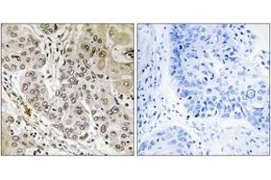 Immunohistochemistry analysis of paraffin-embedded human lung carcinoma tissue, using STK36 Antibody. (STK36 抗体  (AA 387-436))