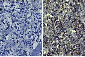 Paraffin embedded human kidney cancer tissue was stained with Mouse IgG1-UNLB isotype control followed by HRP conjugated Anti-Mouse Ig secondary antibody, DAB, and hematoxylin.