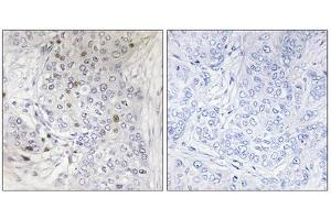 Immunohistochemistry analysis of paraffin-embedded human breast carcinoma tissue, using MAFF antibody. (MafF 抗体  (Internal Region))