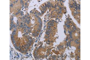 Immunohistochemistry of Human colon cancer using PRKD3 Polyclonal Antibody at dilution of 1:50 (PRKD3 抗体)