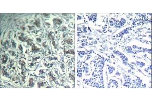 Immunohistochemical analysis of paraffin-embedded human breast carcinoma tissue using PLC-γ1 (Ab-771) Antibody (E021523). (Phospholipase C gamma 1 抗体)
