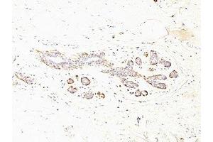 Formalin-fixed, paraffin-embedded human breast carcinoma stained with SMMHC antibody (MYH11/923 + SMMS-1). (MYH11 抗体)