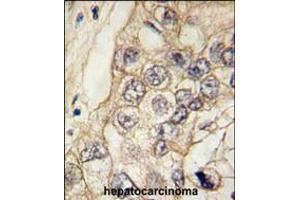 Formalin-fixed and paraffin-embedded human hepatocarcinoma tissue reacted with CDH6 antibody , which was peroxidase-conjugated to the secondary antibody, followed by DAB staining.
