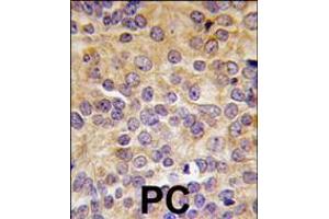Formalin-fixed and paraffin-embedded human prostata carcinoma tissue reacted with PRMT3 antibody (N-term), which was peroxidase-conjugated to the secondary antibody, followed by DAB staining. (PRMT3 抗体  (N-Term))