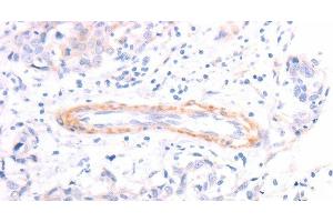 Immunohistochemistry of paraffin-embedded Human breast cancer using TPM1 Polyclonal Antibody at dilution of 1:40 (Tropomyosin 抗体)