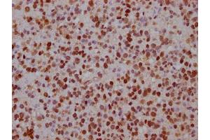 IHC image of ABIN7152619 diluted at 1:100 and staining in paraffin-embedded human glioma cancer performed on a Leica BondTM system. (FABP4 抗体  (AA 6-132))