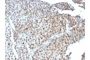 Formalin-fixed, paraffin-embedded human bladder carcinoma stained with anti-p53 antibody (SPM589).