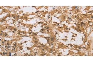 Immunohistochemistry of paraffin-embedded Human thyroid cancer using DAB2 Polyclonal Antibody at dilution of 1:30 (DAB2 抗体)