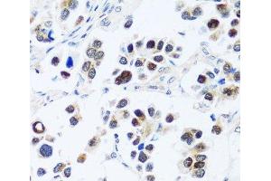 Immunohistochemistry of paraffin-embedded Human lung cancer using BRIX1 Polyclonal Antibody at dilution of 1:100 (40x lens). (BRIX1 抗体)