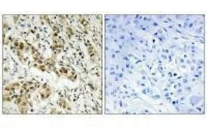 Immunohistochemistry analysis of paraffin-embedded human breast carcinoma tissue using CtBP1 (Ab-422) antibody. (CTBP1 抗体  (Ser422))